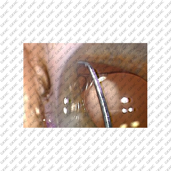 Devgan Universal Cataract Chopper/Multi-Tool (GKHC-26131)