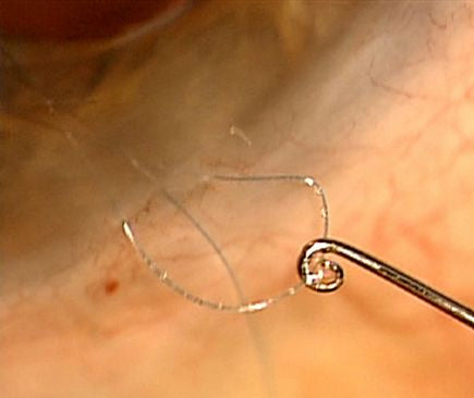 Devgan Intraocular Suturing Hook (E0527)