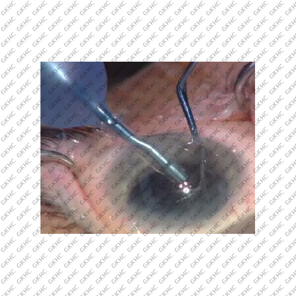 Devgan Universal Cataract Chopper/Multi-Tool (GKHC-26131)